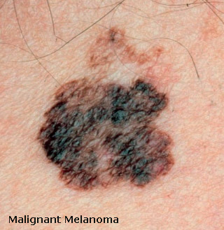 malignant melanoma